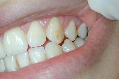 Trattamento delle macchie dei denti e delle piccole carie